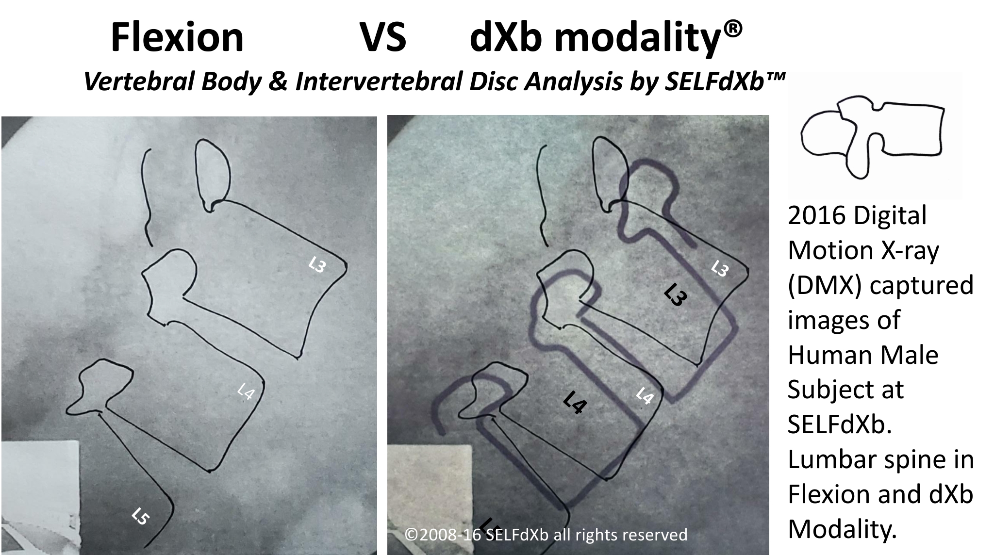 SELFdXb_Flex_vs_dXbM_copyright2024